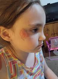 Can children be put to sleep for elbow pin removal?