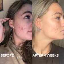 Image result for Azelaic Acid