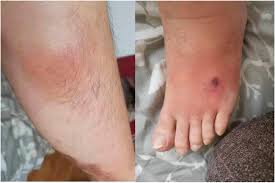 Image result for Pyoderma Gangrenosum