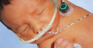 Since your nasal cannula sits inside your nostrils, bacteria can build up inside the tubes over time. High Flow Nasal Cannula Be Careful Out There All Things Neonatal