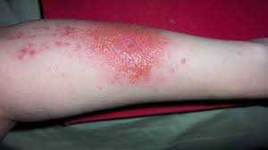 Have your say, get notified on what matters to you and see fewer ads. Eczema Atopic Dermatitis Types Causes Treatment And More