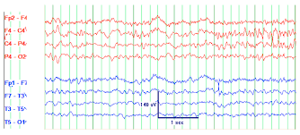 Jcm Free Full Text Acute Encephalitis In An Adult With Diffuse Large B Cell Lymphoma With Secondary Involvement Of The Central Nervous System Infectious Or Non Infectious Etiology Html
