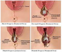 Ia berlaku dalam tempoh selepas bersalin terdapat perubahan fizikal yang tidak diingini yang membawa kepada komplikasi. Tak Perlu Tanya Jenis Jahitan Atau Berapa Banyak Janji Koyakan Ibu Sembuh Semula Pa Ma