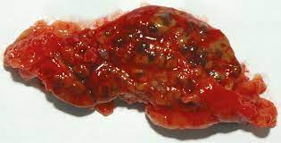 Ppnad is more frequent in females, especially after puberty. Primary Pigmented Nodular Adrenocortical Disease Literature Review And Case Report Of A 6 Year Old Boy