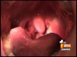 Oral And Neck Cancer Symptoms And Treatments Segment 2 Health 1st Dr Nidhi Patni Youtube