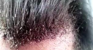 علاج القمل دوائيا ومنزليا باستخدام الطرق الطبيعية والأعشاب Head Louse Men Hairline Louse