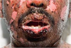 Stevens johnson syndrome or sjs is a type of skin disease that occurs due to drug reaction. Carbamazepine Induced Stevens Johnson Syndrome Bmj Case Reports