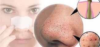 كيفية إزالة البقع السوداء من الوجه بطريقة طبيعية - حياتكَ
