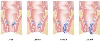 Unterscheidung der formen des hämorrhoidalleidens und behandlung. Hamorrhoidenleiden Universitatsspital Zurich