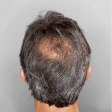 Research conducted by the american hair. Hair Loss Cure Archives Skalp