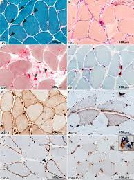 Patching accidental holes slows down the installation process, often by hours. Systemic Sclerosis Associated Myositis Features Minimal Inflammation And Characteristic Capillary Pathology Springerlink
