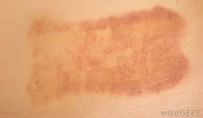 A rash is a widespread breakout of skin lesions, which can vary a lot in appear. What Are The Most Common Symptoms Of Underarm Cancer