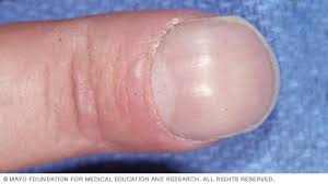 7 مشكلات في أظافر اليد لا ينبغي تجاهُلها - Mayo Clinic (مايو كلينك)