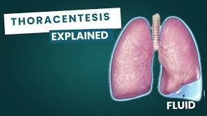 Image result for Thoracentesis