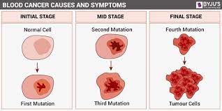 Hematologic cancer or blood cancer develops when the blood cells and bone marrow of a person get affected. Blood Cancer Types Symptoms Causes And Its Treatment