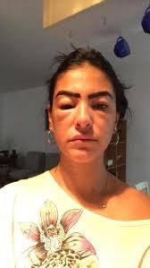 La actriz Liz Gallardo sufre quemaduras en las cejas al someterse a  procedimiento estético
