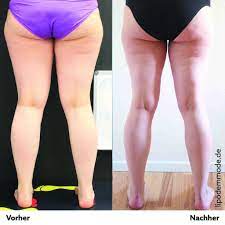 Ein Jahr Post Op Was Hat Die Liposuktion Bewirkt Lipodem Mode