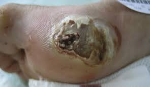 I know i have morgellons aka fly myasis this is working on my 3rd yr. Myiasis Of The Foot And Leg Caused By Chrysomya Bezziana Sciencedirect