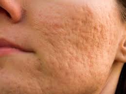 How to treat your chin/jawline pimples? Things That Can Happen When You Pop Your Pimples Insider