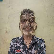 Fewer than 100 cases of hypertrichosis, also known as werewolf syndrome, have been documented in scientific literature and media reports, geneticist xue zhang told new scientist in 2009. Kids Get Werewolf Syndrome From Taking Dodgy Medicine In Spain S Costa Del Sol World News Mirror Online