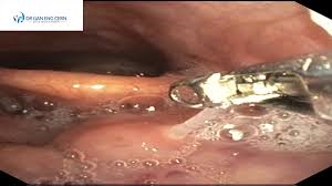 Yeah, it's usually not going to pass on its own, especially if you've been feeling it there for an hour or so. Swallowed A Fish Bone This Is How It Is Removed By An Ent Specialist Dr Gan Eng Cern