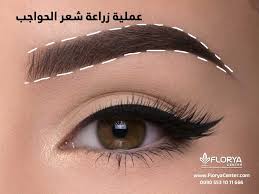 عملية زراعة شعر الحواجب عملية زراعة شعر الحواجب هي عمليات تجميلية ولكن ليس الهدف منها هو التجميل فقط ولكن هناك العديد ممن تعرضوا لحوادث او حروق تركت لديهم تشو
