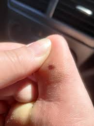 Becomes more irregular in pigmentation including light brown, dark brown; Should I Be Concerned Strange Stain Like Spot Appeared Under Big Toe Melanoma
