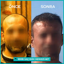 15 Yillik Buyuk Tecrube Ve Uzman Kadromuzla Hayallerinizdeki Saclara Siz De Kavusun Sac Ekimi Sakal Ekimi Sac Mezoterapisi Kas Ekimi Prp He Sac Ekim Sakal