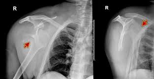 Renal vascular disease affects the blood flow into and out of the kidneys. Cureus Rare Complications Of Seizures In End Stage Renal Disease A Case Report