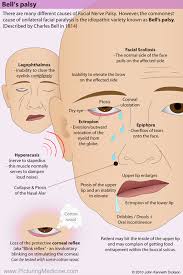 Bell palsy can affect anyone at any age. Bell S Palsy There Are Many Different Causes Of Facial Grepmed