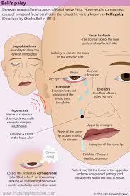 It begins suddenly and worsens over 48 hours. Bell S Palsy There Are Many Different Causes Of Facial Grepmed