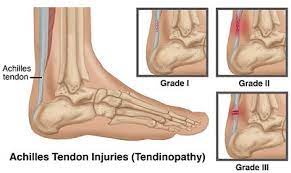 Maybe you would like to learn more about one of these? Achilles Tendonitis Treatment Recovery Foot Pain Explored