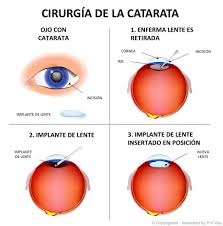Los ojos se vuelven más sensibles a la luz. Cirugia Del Cristalino Cirugia De Catarata