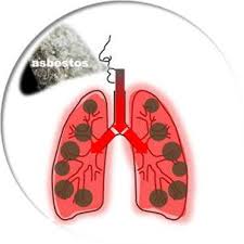 Although asbestos is bad for health, there is nothing to worry about if you have asbestos at home. How Does Asbestos Kill People