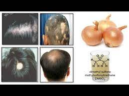 Onion And Hair Growth How To Use Onion Juice The Right Way To Prevent Hair Los 2016 Youtub Onion Juice For Hair Natural Hair Regrowth Hair Regrowth Shampoo