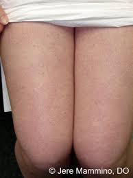 Keratosis pilaris is a common, harmless skin condition that causes small bumps to appear on the skin. Keratosis Pilaris American Osteopathic College Of Dermatology Aocd