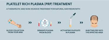 Prp hair treatment, the treatment is combined with a hair transplantation operation. Prp Treatment For Hair Loss Cost And Success Rate In India 2020