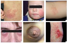 Image result for dermatitis contacta children