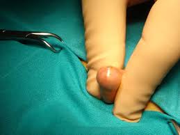 Image result for Phimosis