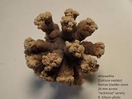 Image result for Calcium Nephrolithiasis