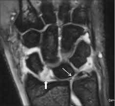 Ruptur des discus des tfcc am fovealen und styloidalen ansatz. Triangular Fibrocartilage Tfc Or Tfcc Injuries Dr Groh