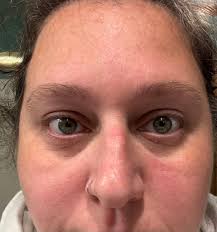 I just feel tired all the time. And I get winded as im walking down the  hallway at work as cna. I was in hospital for fluid