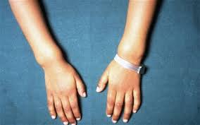 Image result for Rickets