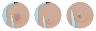 Image result for Inflammatory breast cancer