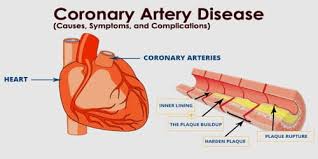 However, coronary heart disease , or chd, is actually a result of coronary artery disease, or cad with coronary artery disease, plaque first grows within the walls of the coronary arteries until the. Coronary Artery Disease Causes Symptoms And Complications Assignment Point