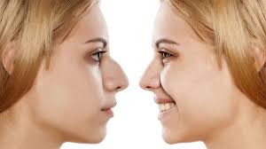 Cosmetic Rhinoplasty Surgeons Philadelphia