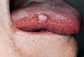 Image result for white cancer on tongue)