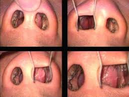 What Is A Deviated Septum And How To Repair It Sinus Cavities Rhinoplasty Nose Jobs Nasal Septum