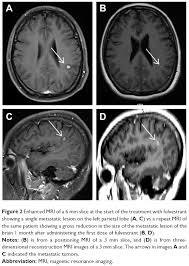 Sometimes people with metastatic breast cancer do not have any of these changes. Brain Metastases From Breast Cancer May Respond To Endocrine Therapy Ott