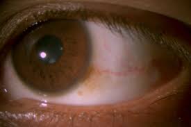 Image result for melanosis sclera